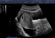 SonoScape E2 Pro Ultrasound