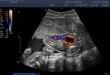 SonoScape E2 Pro Ultrasound